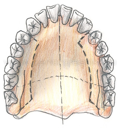 Секторальная остеотомия латерального отдела верхней челюсти