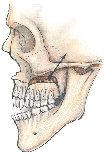 Секторальная остеотомия латерального отдела верхней челюсти