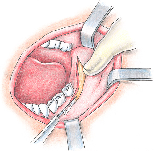 Пластика челюсти