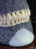 Пластика подбородка