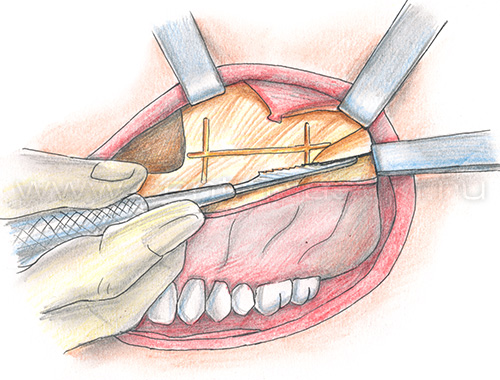 Увеличение проекции средней зоны лица имплантами