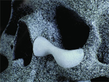 Изменение формы параорбитальной области имплантами