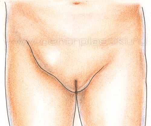 Паховая грыжа у девочки