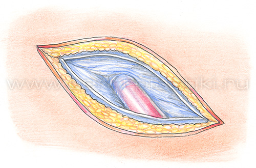 Паховая грыжа у детей