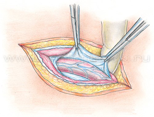 Паховая грыжа у детей