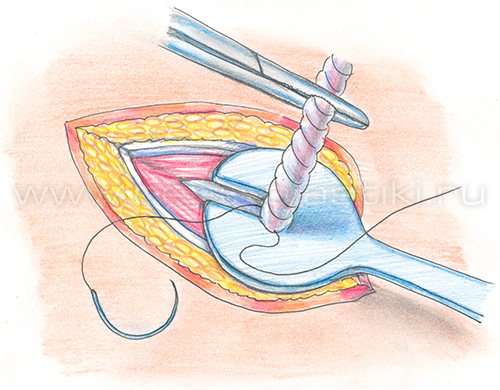 Паховая грыжа у детей