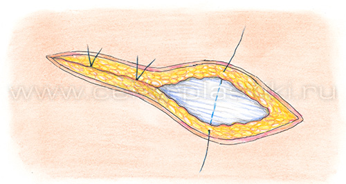 Паховая грыжа у детей