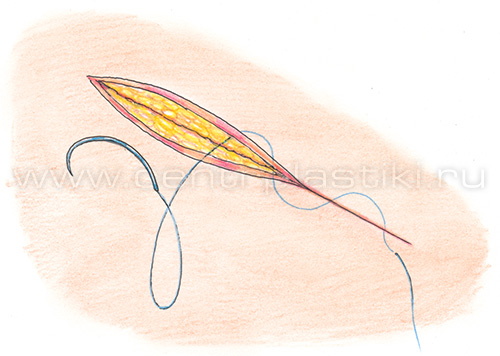 Паховая грыжа у детей