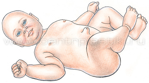 Пупочная грыжа у детей