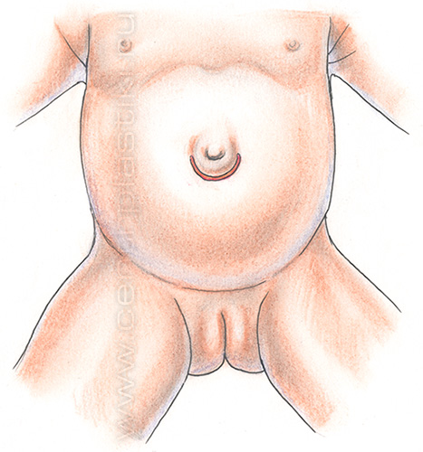 Пупочная грыжа у детей