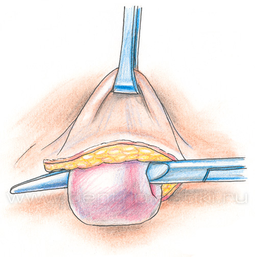 Пупочная грыжа у детей