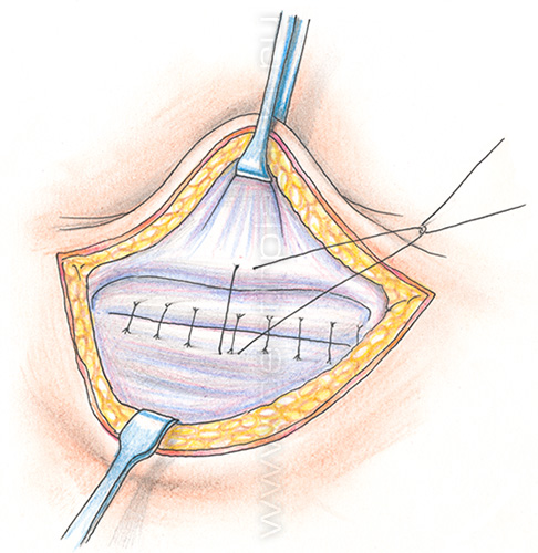 Пупочная грыжа у детей