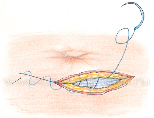 Пупочная грыжа у детей