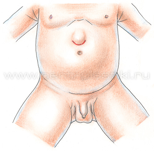 Грыжа белой линии живота у детей