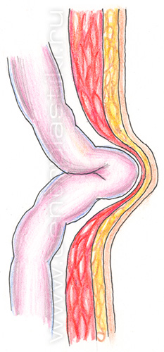 Грыжа белой линии живота у детей