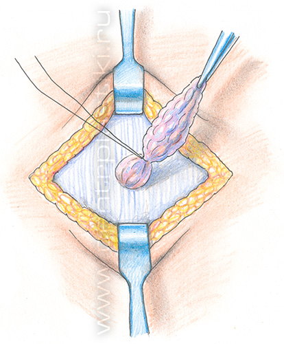 Грыжа белой линии живота у детей