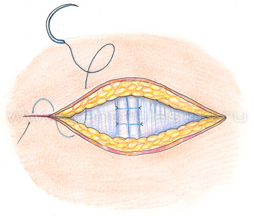Грыжа белой линии живота у детей