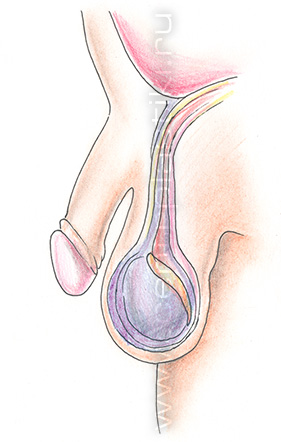 Водянка яичка