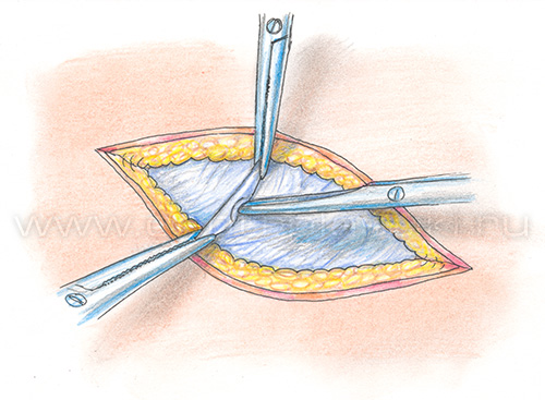 Паховая грыжа у детей