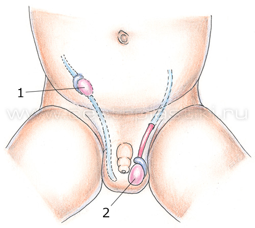 Крипторхизм