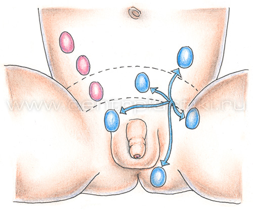 Крипторхизм