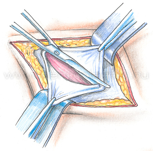 Крипторхизм