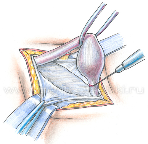 Крипторхизм