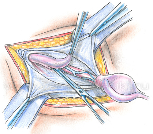 Крипторхизм