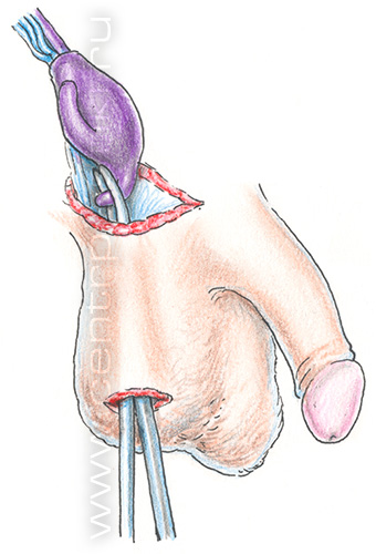 Крипторхизм