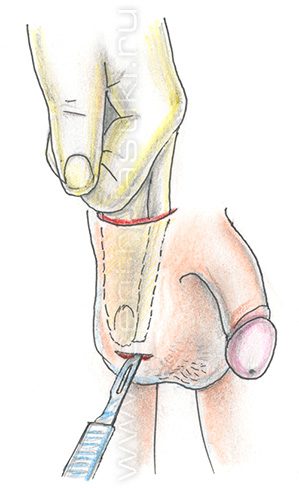 Крипторхизм