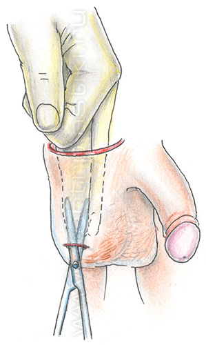 Крипторхизм