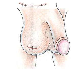 Крипторхизм