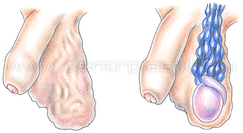 Варикоцеле