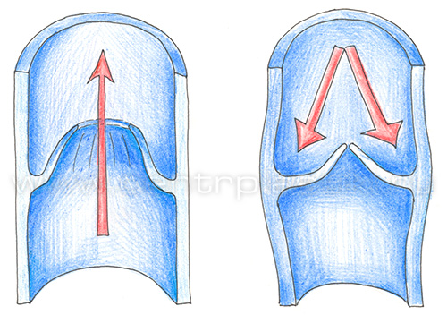 Варикоцеле