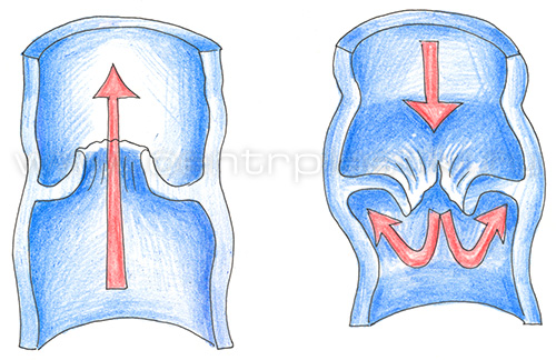 Варикоцеле