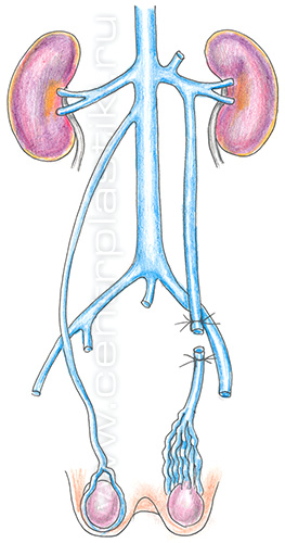 Варикоцеле
