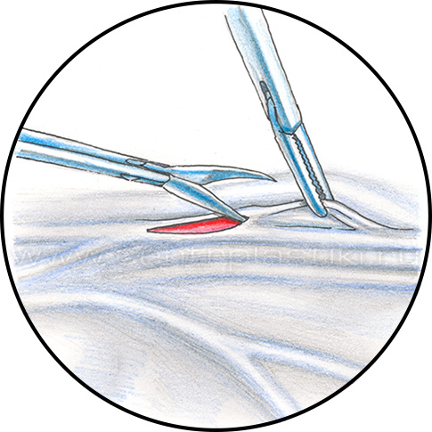 Варикоцеле