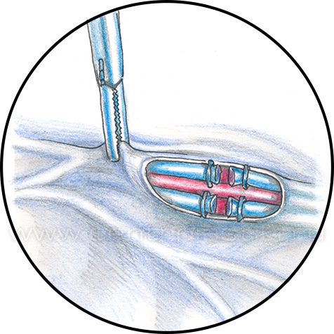 Варикоцеле