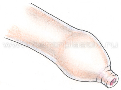 Норма. Фимоза нет