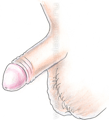 Норма. Фимоза нет