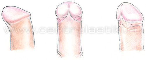 Короткая уздечка