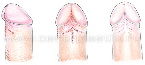 Короткая уздечка: операция