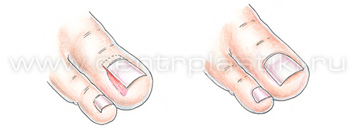 Вросший ноготь у ребенка, удаление