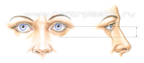 Операции на веках