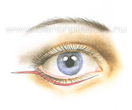 Операции на веках