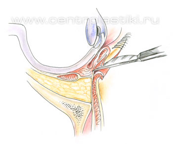 Операции на веках