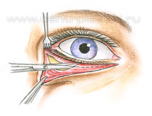 Операции на веках