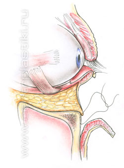 Операции на веках
