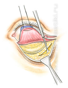 Операции на веках