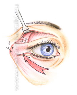Операции на веках